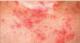 PSORIASIS